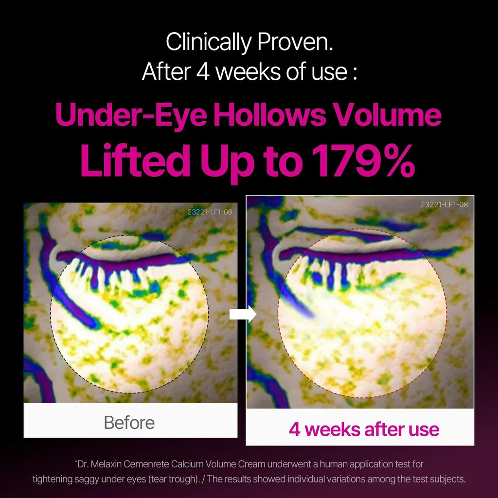 Calcium Intense Cream — under-eye hollow volume lifted up to 179% after 4 weeks