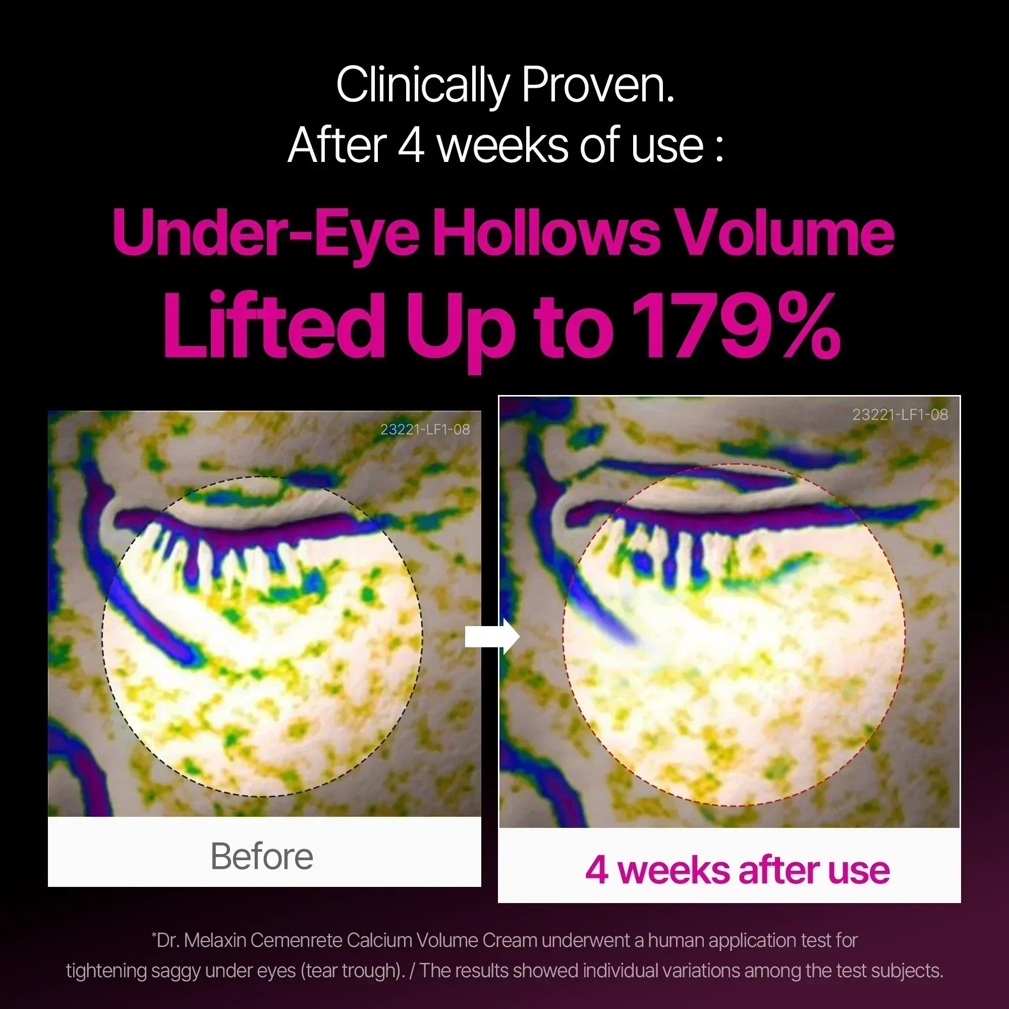 Calcium Intense Cream — under-eye hollow volume lifted up to 179% after 4 weeks