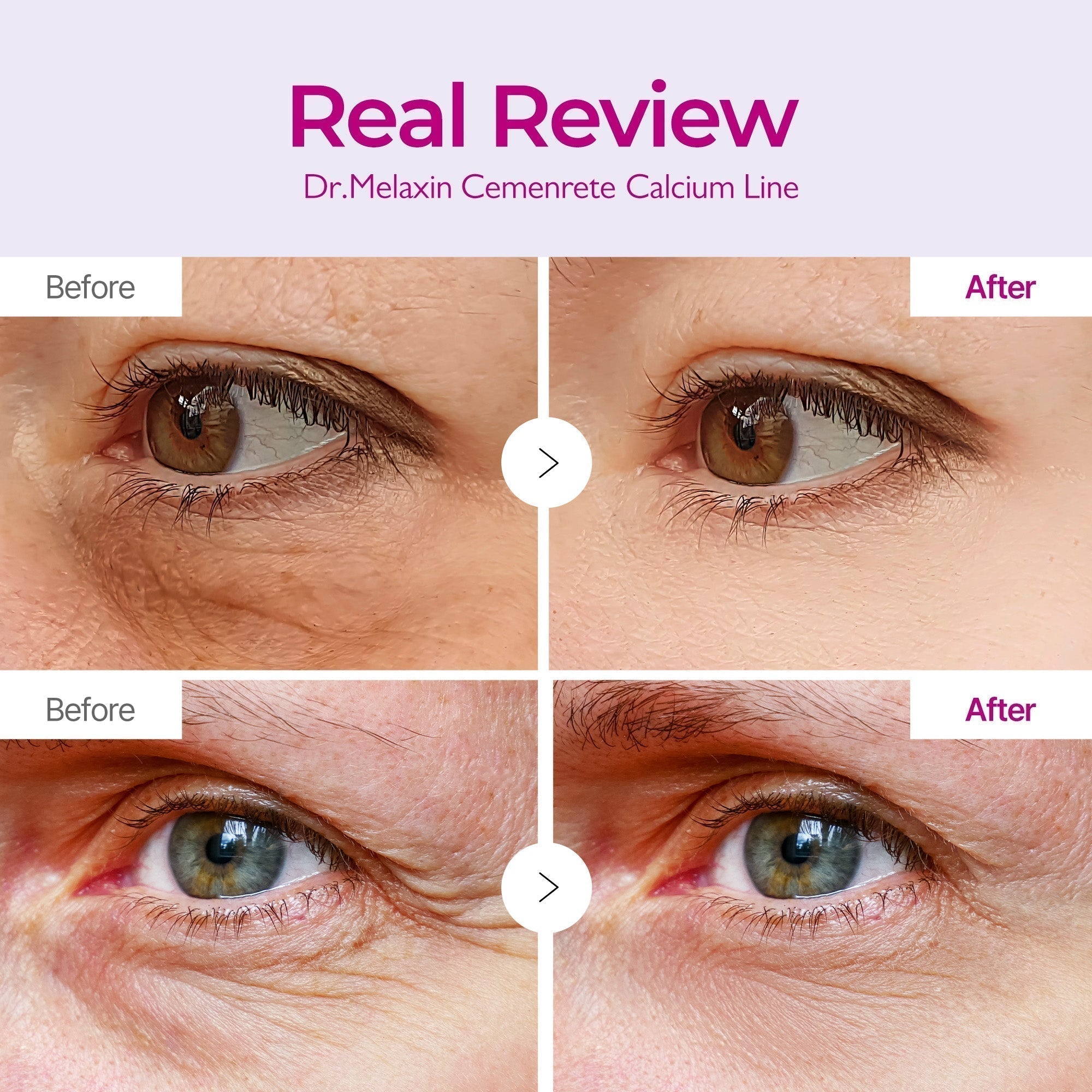 Cemenrete Calcium eye patch real review before and after