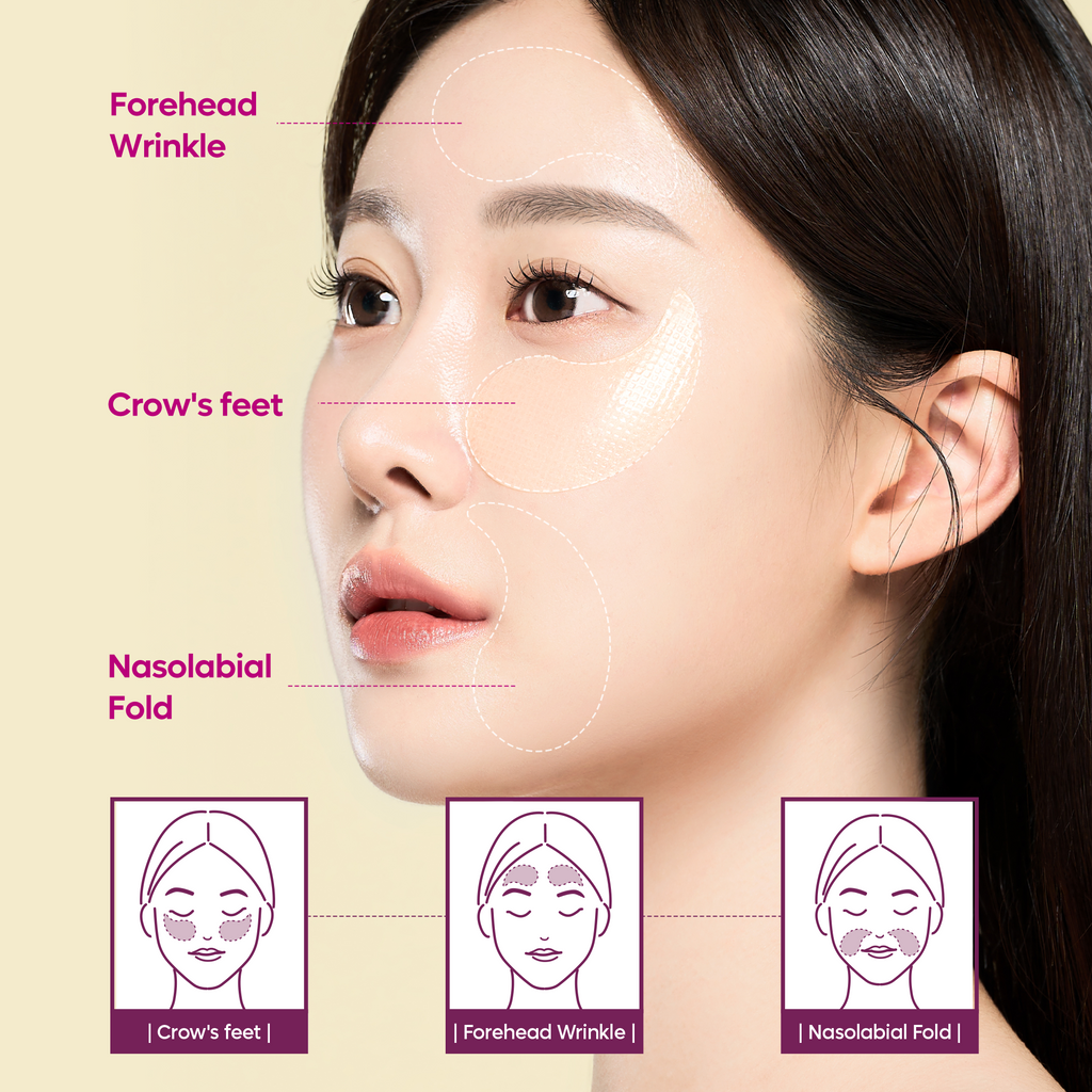 Where to use — crow’s feet, forehead wrinkles and nasolabial folds