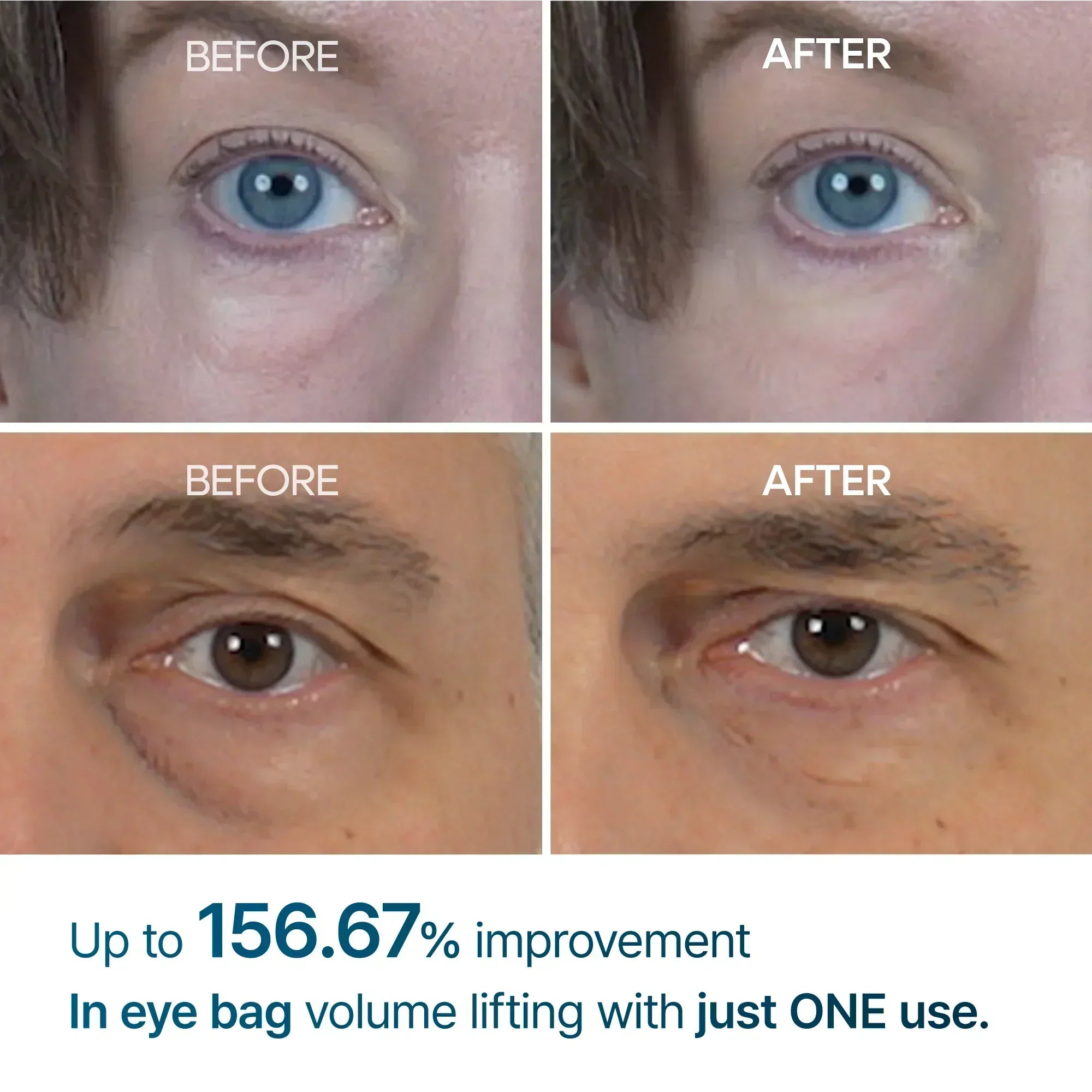Eyephalt Eyebag Cream before and after — up to 156.67% eye bag improvement