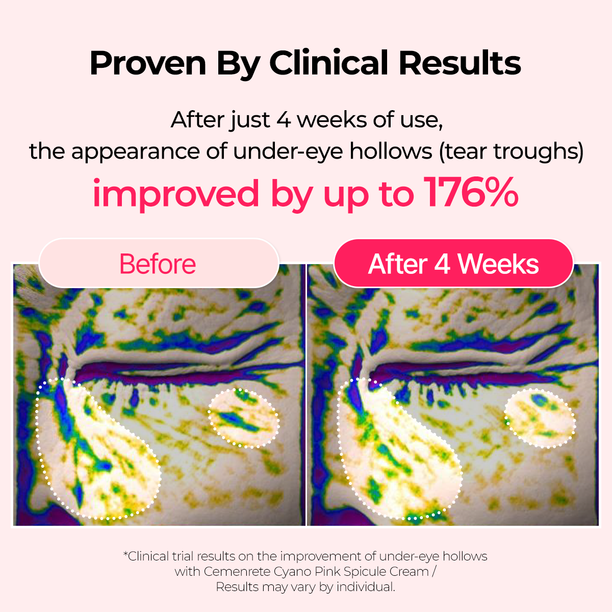 Cyano Pink Spicule Cream — tear troughs improved up to 176% after 4 weeks